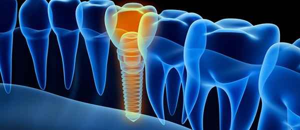x-ray image of an implant