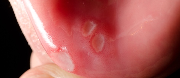 Photo of oral blisters