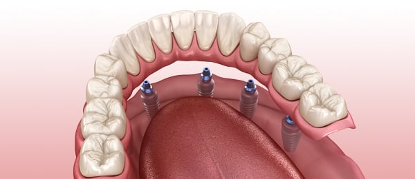 Full-arch implant prostheses and technical complications