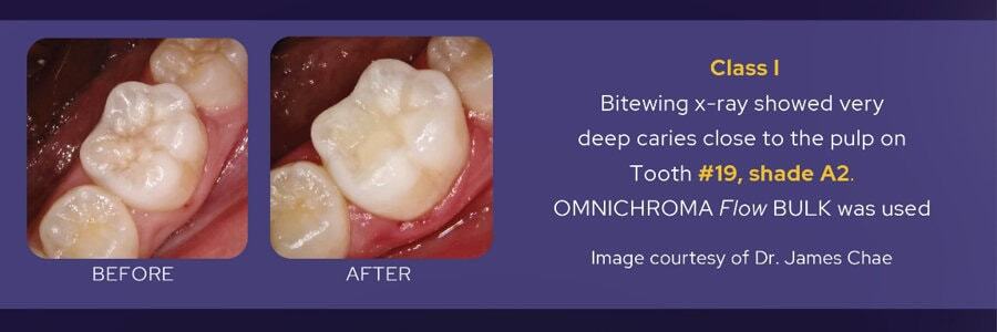BEFORE/AFTER Class I : Bitewing x-ray showed very deep caries close to the pulp on Tooth #19, shade A2. OMNICHROMA Flow BULK was used - Image courtesy of Dr. James Chae