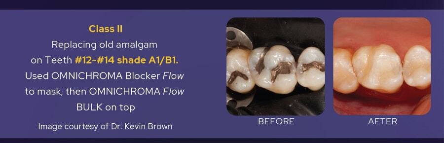 BEFORE/AFTER Class II : Replacing old amalgam on Teeth #12-#14 shade AI/BI. used OMNICHROMA Blocker Flow to mask, then OMNICHROMA Flow BULK on top - Image courtesy of Dr. Kevin Brown