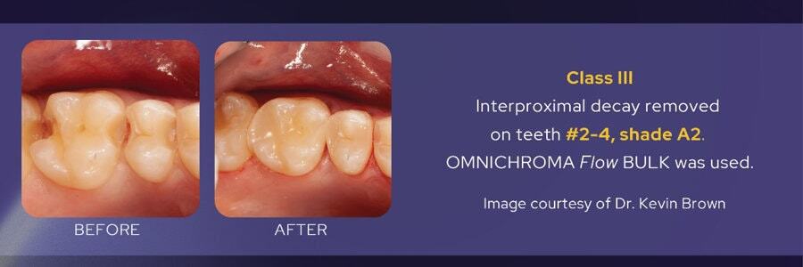BEFORE/AFTER Class Ill : Interproximal decay removed on teeth #2-4, shade A2. OMNICHROMA Flow BULK was used. - Image courtesy of Dr. Kevin Brown